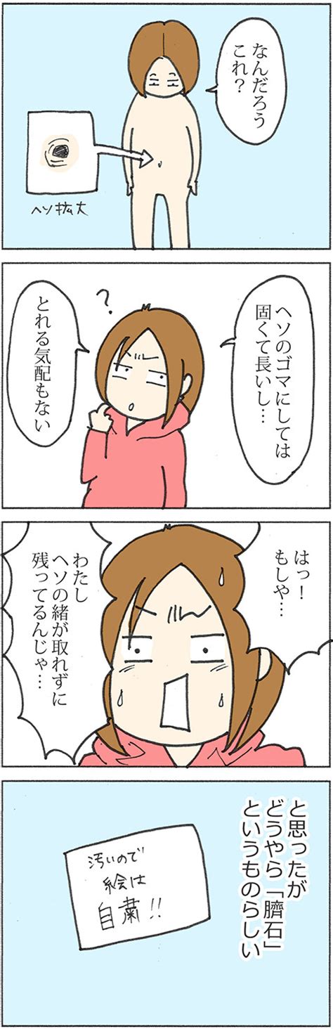 臍石除去|47話「妊婦になって初めてわかった臍石」 – かたく。